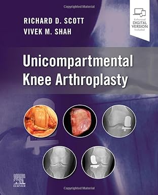 [B9780323790109] Unicompartmental Knee Arthroplasty: 1ed